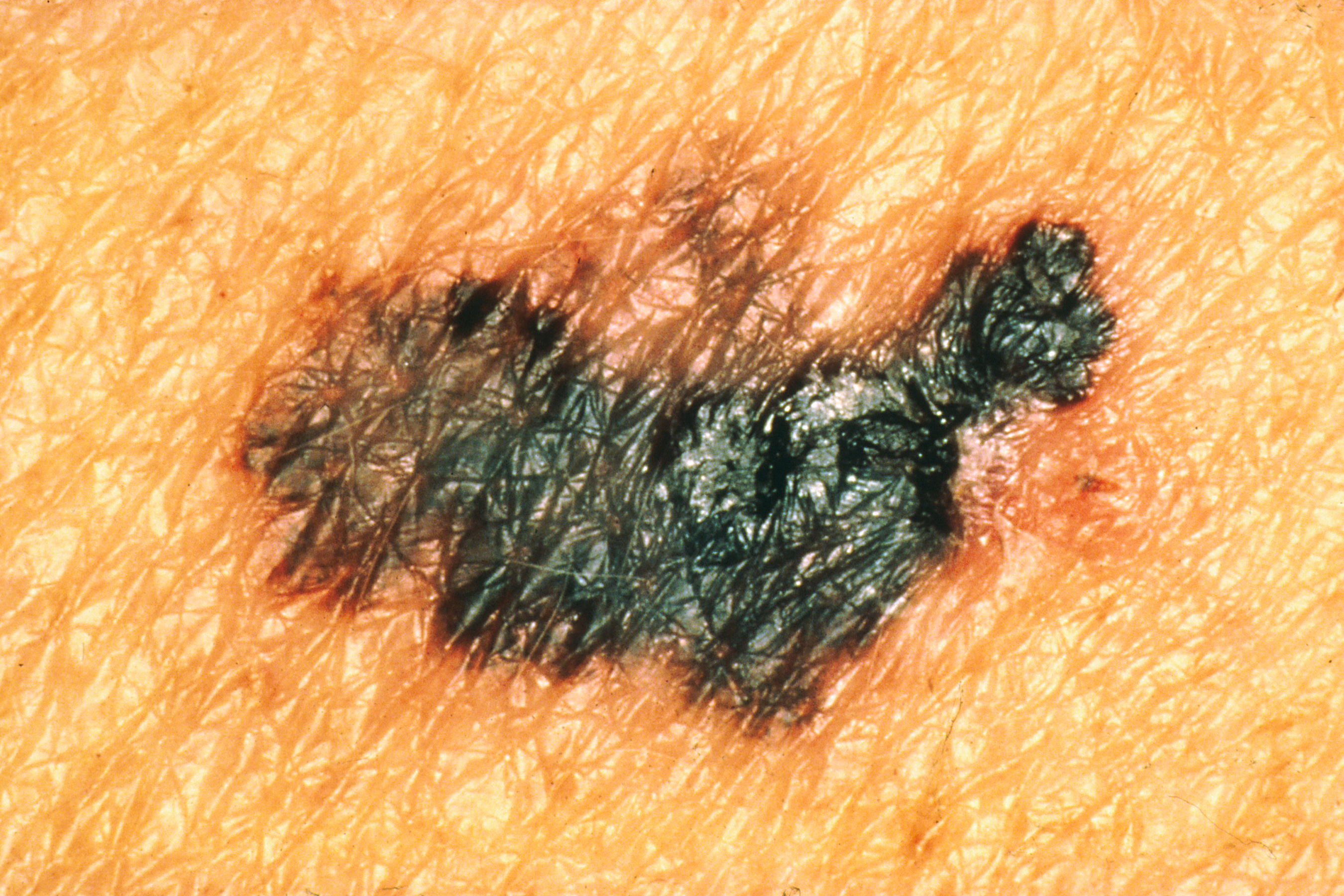 Malignes Melanom